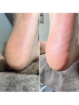 ビューティサロン チル(beauty salon chill)/フット角質ケア