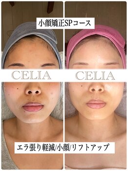 セリア(CELIA)/小顔/小顔矯正