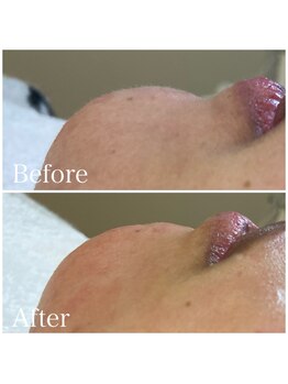 ロリー(LOLiE)/顎下wax