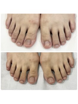 エルナ(elna)/足の深爪も長さ出しが可能です!