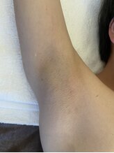アレッド 大阪店(ared.)/脇毛脱毛で蒸れや匂いスッキリ