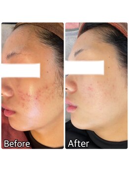 ドクター小顔 銀座店(Dr.小顔)/ニキビケア・赤み肌・毛穴