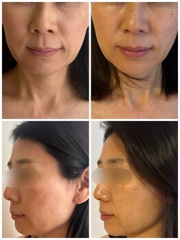 ルアンビューティー メディカルプラス(Luan beauty MEDICAL+)/チタニウムリフト×1回