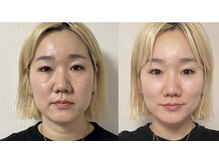 ミー(Me)の雰囲気（結果重視!インスタで話題のお顔の筋トレマシ-ンテラボ-ラ-導入）