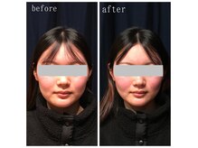 たくろう鍼灸院 豊田本院の雰囲気（【美容鍼BeforAfter】フェイスラインたるみ改善《２》）