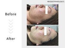 美活ラボ(美活LABO)/ハーブピーリング