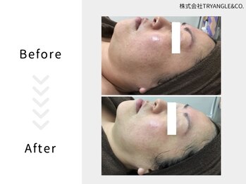 美活ラボ(美活LABO)/ハーブピーリング