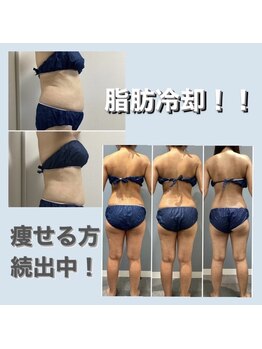 プリマプリート 島店/脂肪冷却 大人気☆