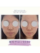 ベベ(Bebe)/光フェイシャル♪