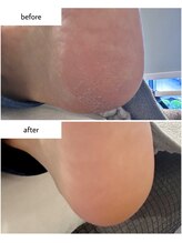 ケアプラス(care plus)/足裏角質ケア