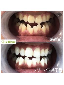 ルブラン 奈良店(Le Blanc)/自信を持てる歯に!