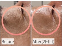 ハーブピーリング/毛穴/シミ/小顔