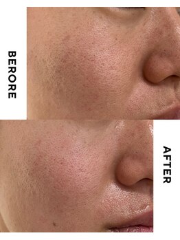 ブルーム(BLOOM)/ウイッシュプロピーリング