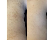 ララン La.Lanの雰囲気（グリーンピールボディシングル計２回の経過）