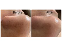 ケー(K)/毛穴洗浄×ワックス