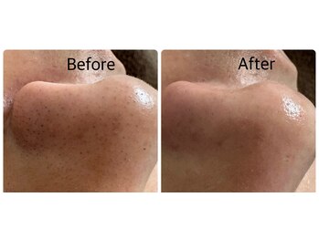 ケー(K)/毛穴洗浄×ワックス