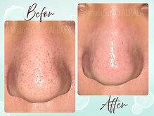 アルパカ(ALPACA)の雰囲気（【missHANAKO】常在菌コントロール毛穴ケア★１回の施術効果です）