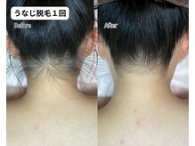 レミーラ(Remira)の雰囲気（【うなじ脱毛】1回照射でスッキリ！！）