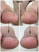 名古屋駅前巻き爪センター/巻き爪