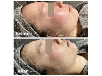 シュシュ(Chou chou)/【Before★After】赤み・乾燥