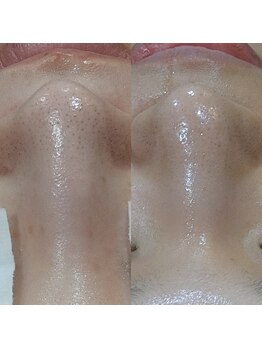 ボーソリューション(Beau-Solution)/【30代　サマー水光ピーリング】