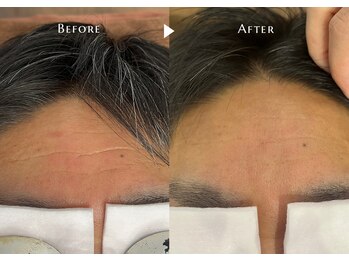 シャイニー/光フェイシャル5回