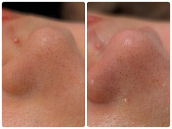 マリアム(mariam)/毛穴エクストラクション角栓撃退