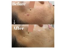 カラーリリー アンド ユン(Calla lily & yun)/ハーブピーリングでニキビケア