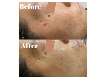 カラーリリー アンド ユン(Calla lily & yun)/ハーブピーリングでニキビケア