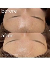 ルルラ リコ(lulula rico)/症例写真/ハーブピーリング