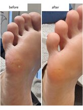 ケアプラス(care plus)/足裏角質ケア