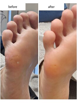 ケアプラス(care plus)/足裏角質ケア