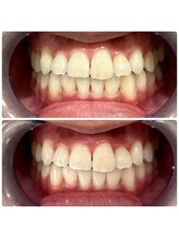 コナホワイトニング 神保町/ホワイトニング