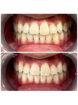 コナホワイトニング 神保町/ホワイトニング