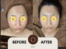 ベリル(BERYL)/【皮向け・赤み】バリア機能回復