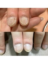 ミュゼドゥリッシュ(musee du riche)/深爪矯正・自爪育成