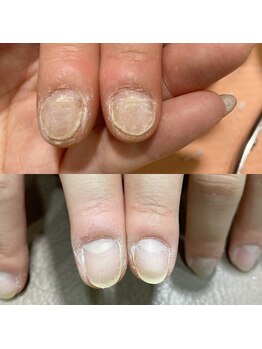 深爪矯正・自爪育成