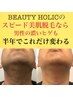 《男性ヒゲ脱毛体験》結果重視の最新美容脱毛・1日限定1名¥1500