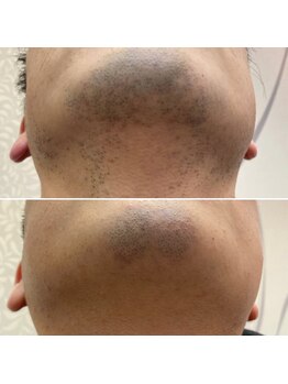 エピシアドットエヌ(epicia.N)/途中経過☆4ヶ月後