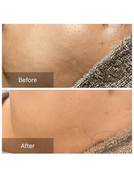 ルポアミ 代々木上原(REPOS AMI)/プラズマフェイシャル 2回の変化