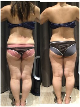 アイスタイル(i-style)/脂肪冷却/痩身ダイエット/泉大津