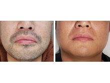 セブンボーテ(7Beaut'e)/ひげ脱毛