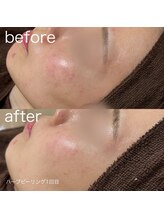 ルルラ リコ(lulula rico)/症例写真/ハーブピーリング