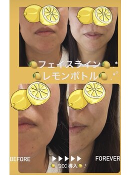 アイズ ビューティケア(eyes. beauty care)/レモンボトル 取りたい脂肪に！
