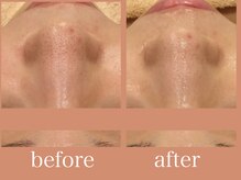 エピラックス(epilax)/ハイドラフェイシャル