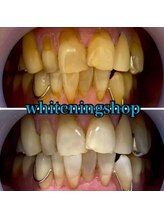 ホワイトニングショップ 武蔵小杉店/【BeforeAfter】8回施術比較