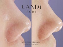 キャンディ 天王寺(CANDi)/ハイドラピーリング黒ずみ毛穴◎