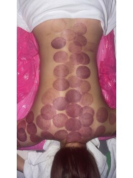 中国整体 らくらく堂/温熱療法吸い玉深層腰リンパケア