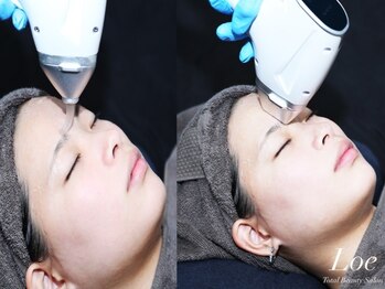 ロエ(Loe)の写真/痛みは最小限!効果は最大限!最新の"LED脱毛"で最短半年で脱毛卒業♪鼻毛/耳毛/眉毛もしっかり照射します◎