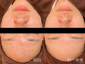 ウォーム(warm)/【肌質改善専門店warm】肌質改善